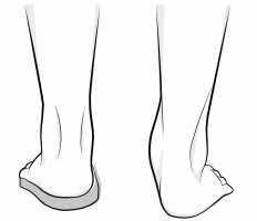 foot pronation with and without orthotic