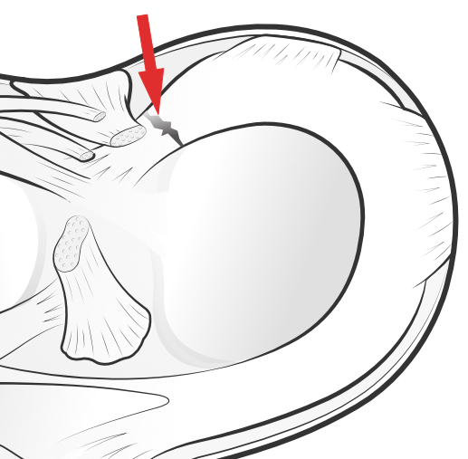 root tear of the meniscus