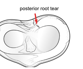 posterior meniscus root tear