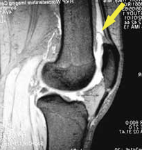 suprapatellar plica