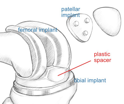 components of a total knee replacement